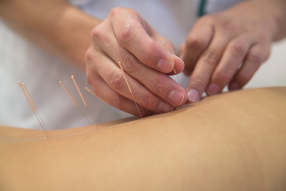 Treatment by Medical acupuncture at Loxwood Clinic